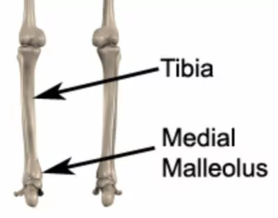 Medial Malleolus and Tibia