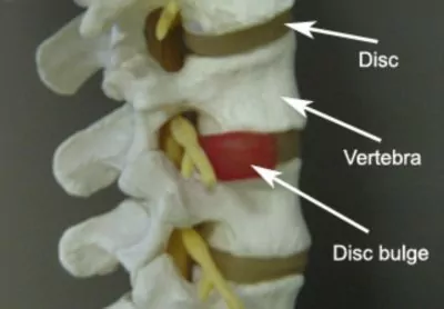 Lower Back Pain Diagnosis - Disc Bulge Anatomy