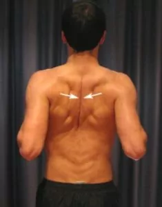 Exercises for a Frozen Shoulder - Shoulder Blade Squeezes