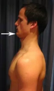 Exercises for a Wry Neck - Chin Tucks