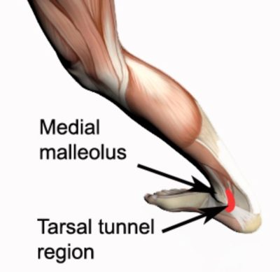 Tarsal Tunnel Syndrome Anatomy