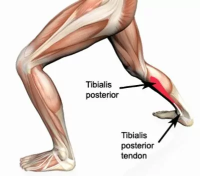 Relevant Anatomy for Tibialis Posterior Tendonitis