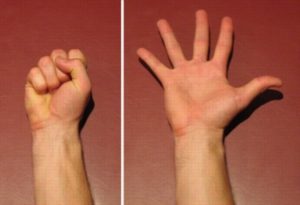 Exercise for a Dislocated Finger - Hand Open to Close