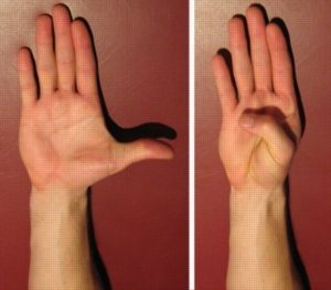 Exercises for a Sprained Thumb - Thumb Extension to Flexion