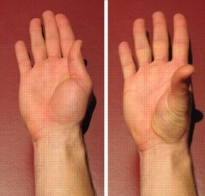 Hand Exercise - Thumb adduction abduction