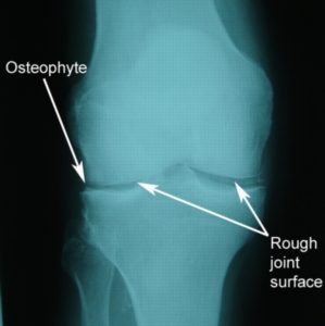 X-ray Demonstrating Knee Arthritis