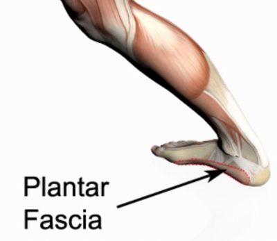 Plantar fasciitis radiating on sale pain