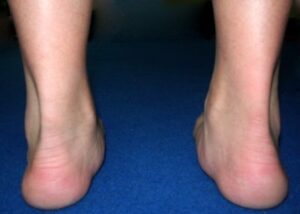 Do I Need Orthotics? Pronated (Flat) Feet