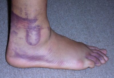 Swelling and Bruising associated with a Sprained Ankle
