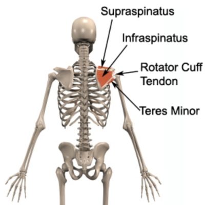 Torn rotator cuff