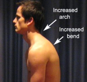 Thoracic Postural Syndrome - Poor Posture