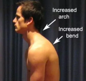 Costovertebral Joint Sprain - Poor Posture