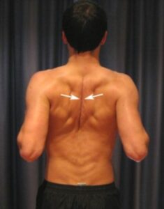 Shoulder Blade Squeeze Exercise for an AC Joint Sprain