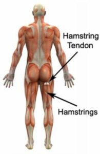 Ischiogluteal Bursitis Ischial Bursitis PhysioAdvisor