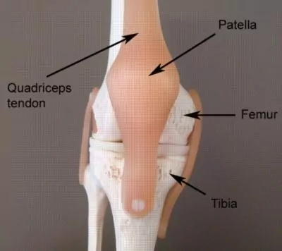 Fractured patella deals no pain