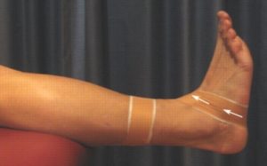 Ankle Strapping - Figure-of-6s (Lateral)