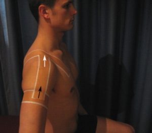 Shoulder Taping - Straight Lines