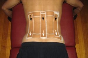 Back Strapping - Vertical Lines
