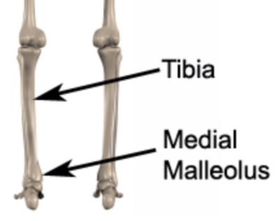 Medial Malleolus Fracture Anatomy