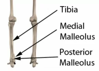 Pott's Fracture Anatomy - Medial & Posterior Malleolus