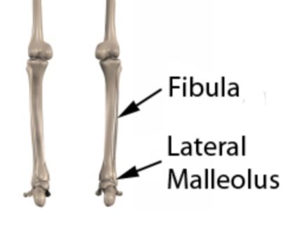 Pott's Fracture Anatomy - Lateral Malleolus