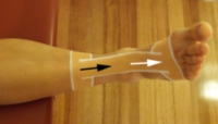 Posterior Ankle Impingement Taping