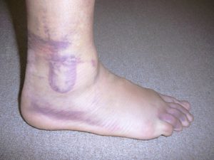 Inflammatory Pain Following a Sprained Ankle