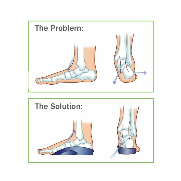 Talar Made Orthotics - 3 4 Length Orthotics - Physioadvisor